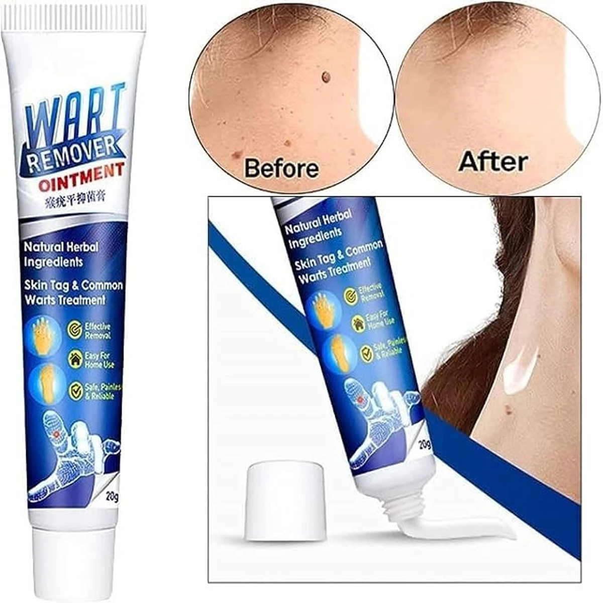 Wart Skin Tag Removal Ointment