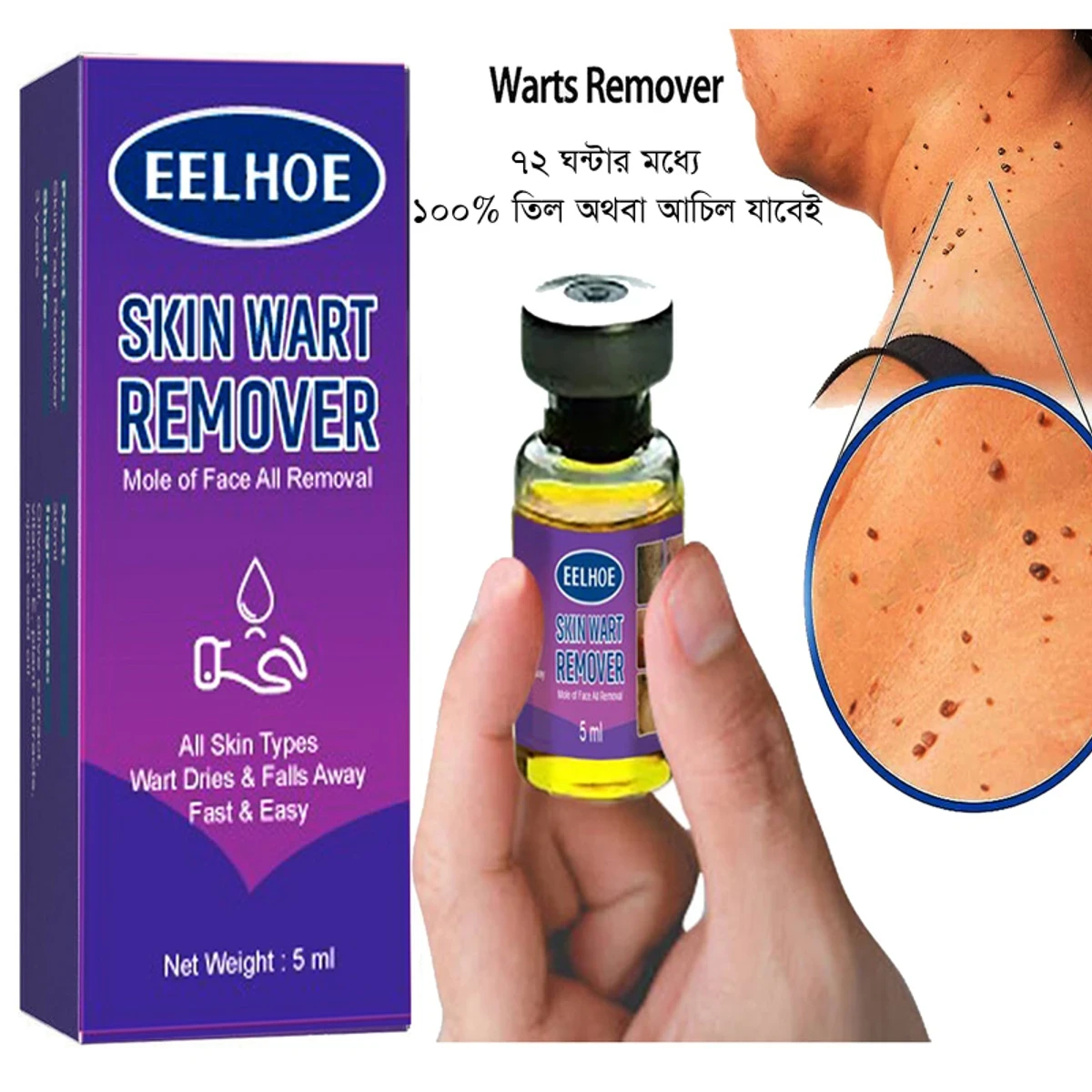 Skin Wart Remover (৭২ ঘন্টার মধ্যে ১০০% তিল অথবা আঁচিল যাবেই)