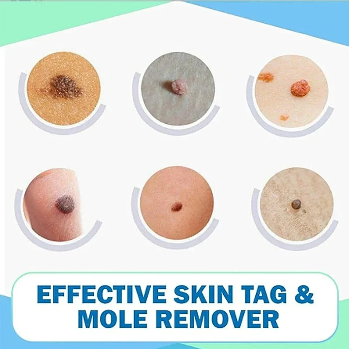 Freckle Removal Cream Moisturizing Moisturizing